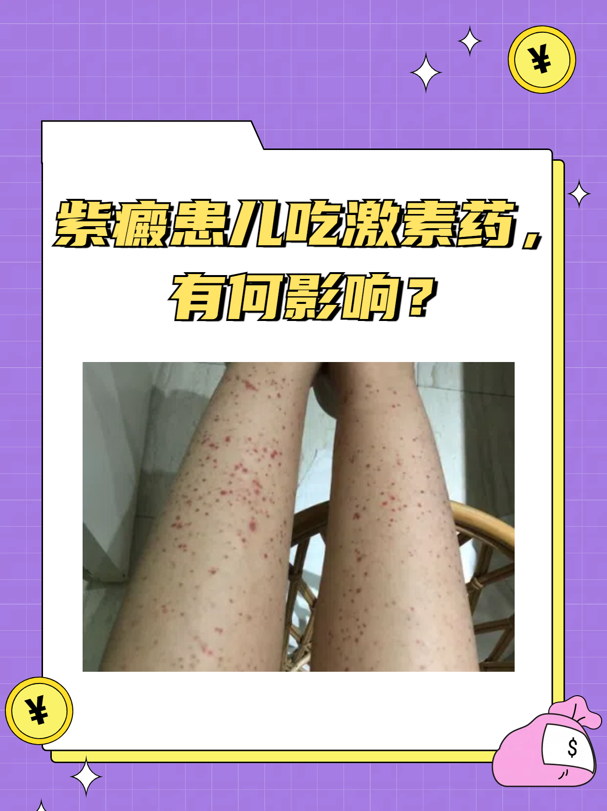 紫癜患儿吃激素药,有何影响?