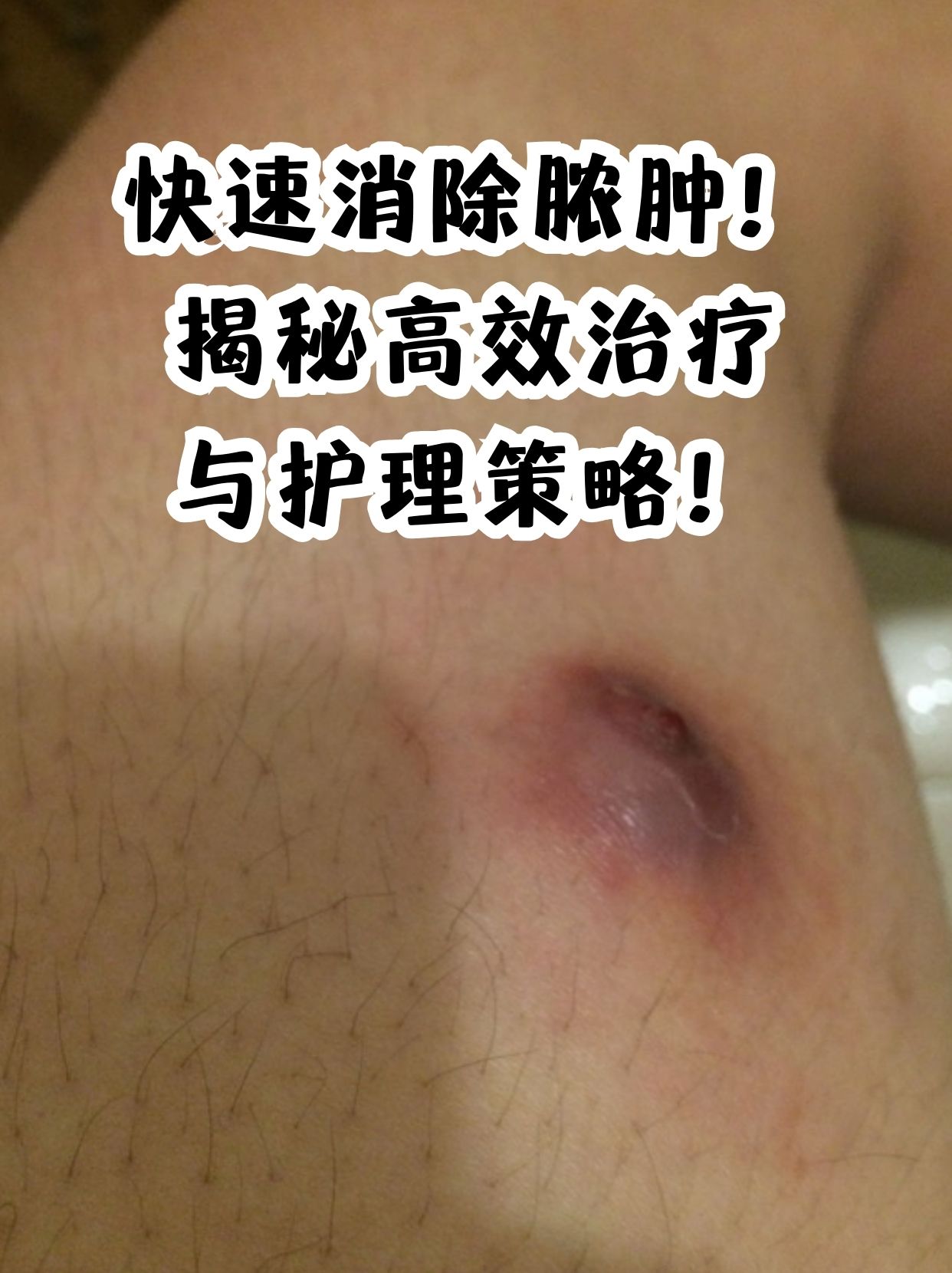 贴膏药为什么会拔出脓