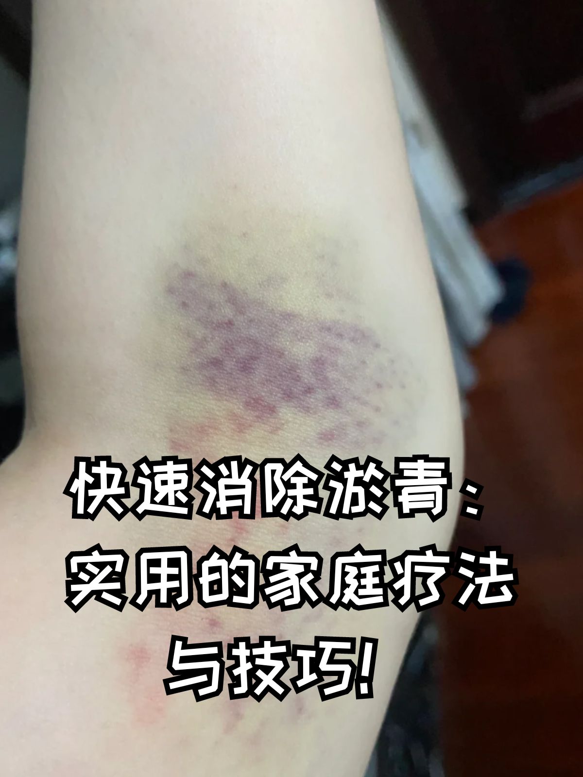 为什么会有淤血