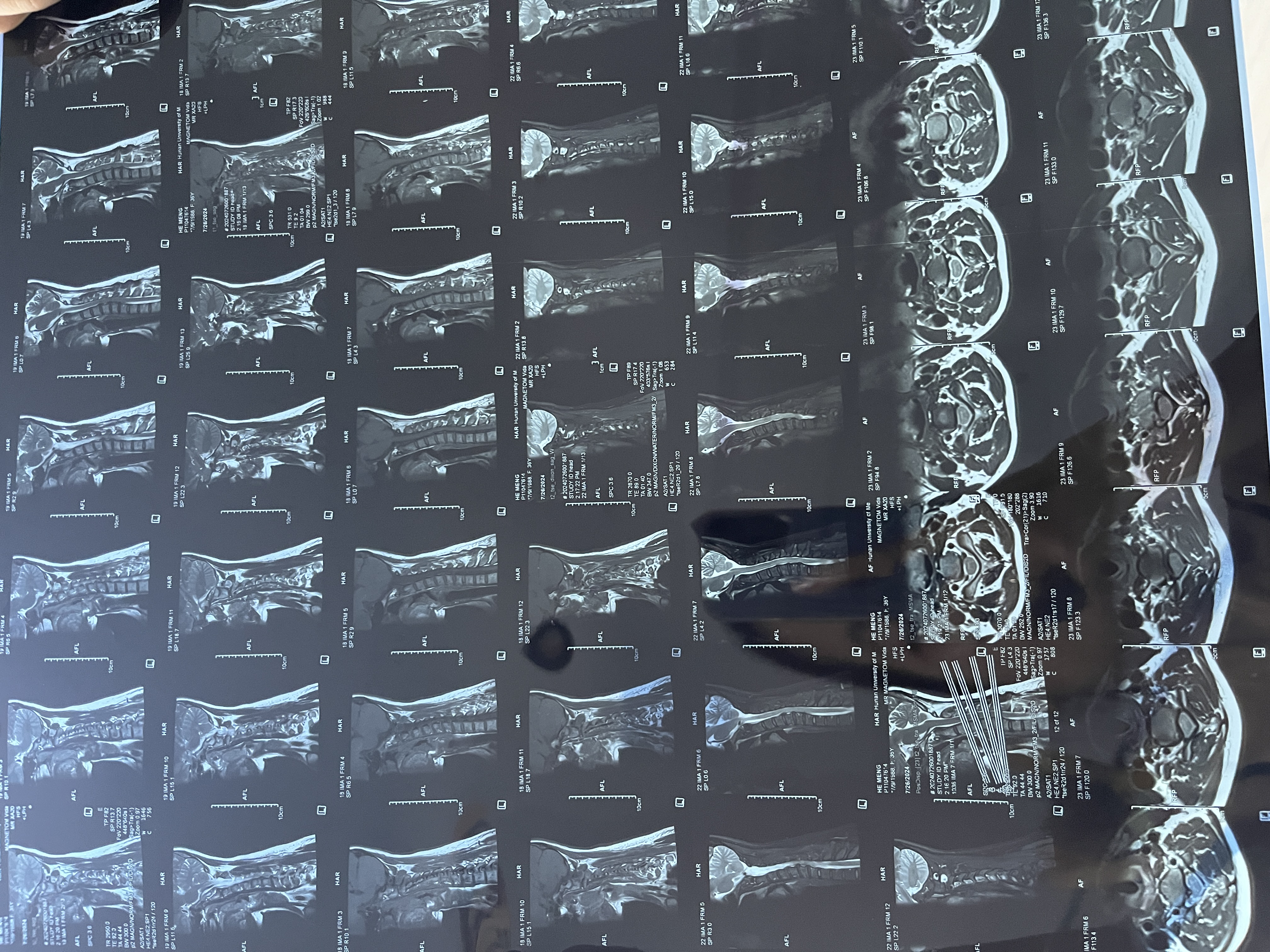 2级:颈部,肩膀和后颈椎ct颈椎ct图片颈椎片子