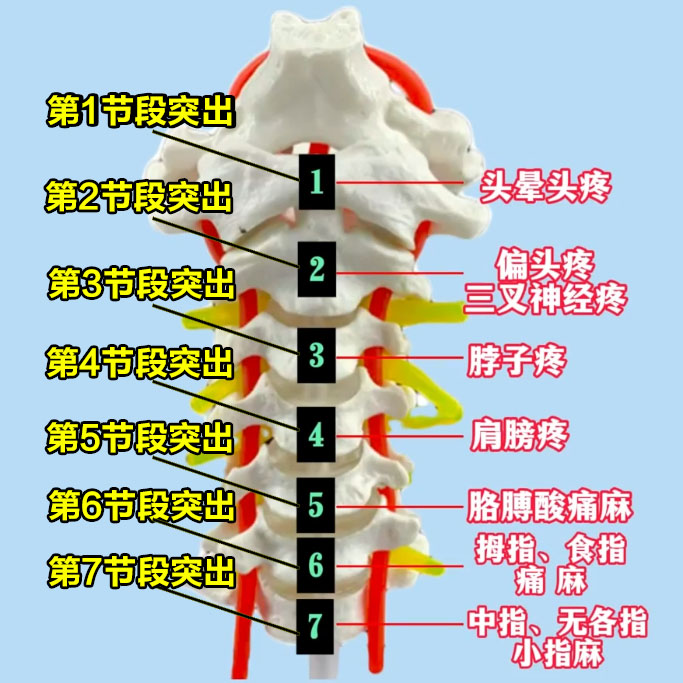 颈椎间盘突出的情况较为复杂,其突出节段不同时,所呈现的症状也大相