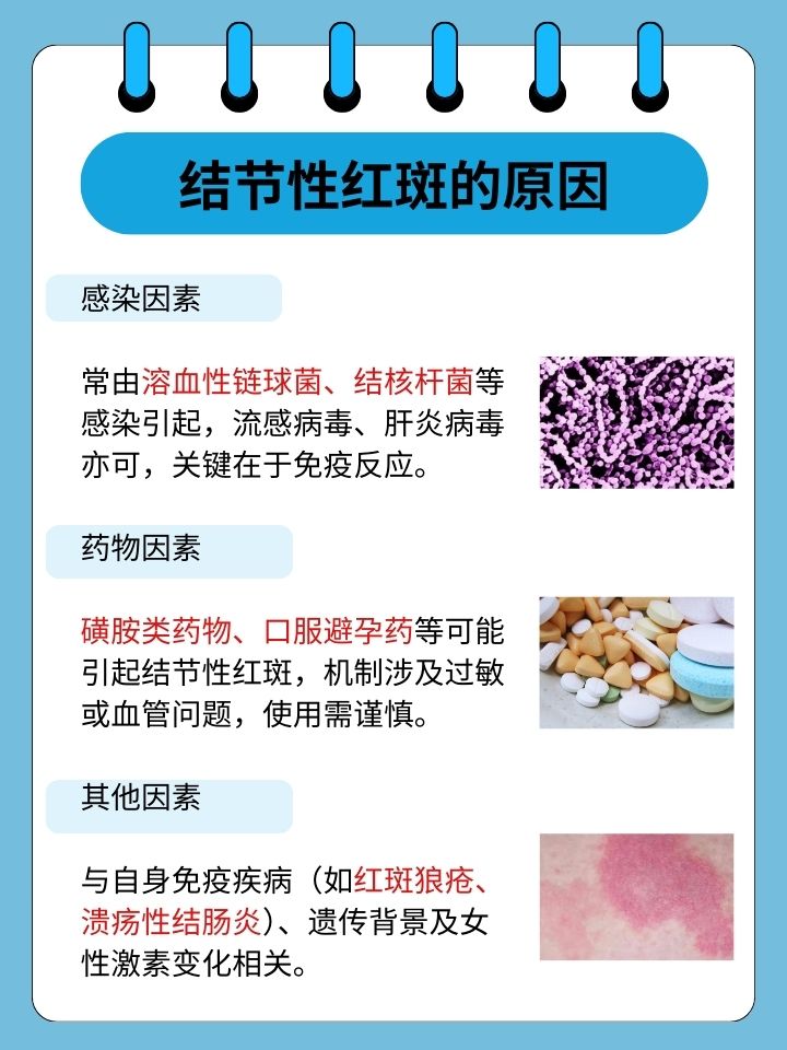 结节性红斑的原因,探究发病根源