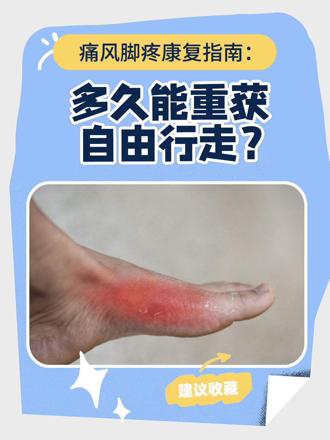 痛风脚疼通常第一次发作在3至5天