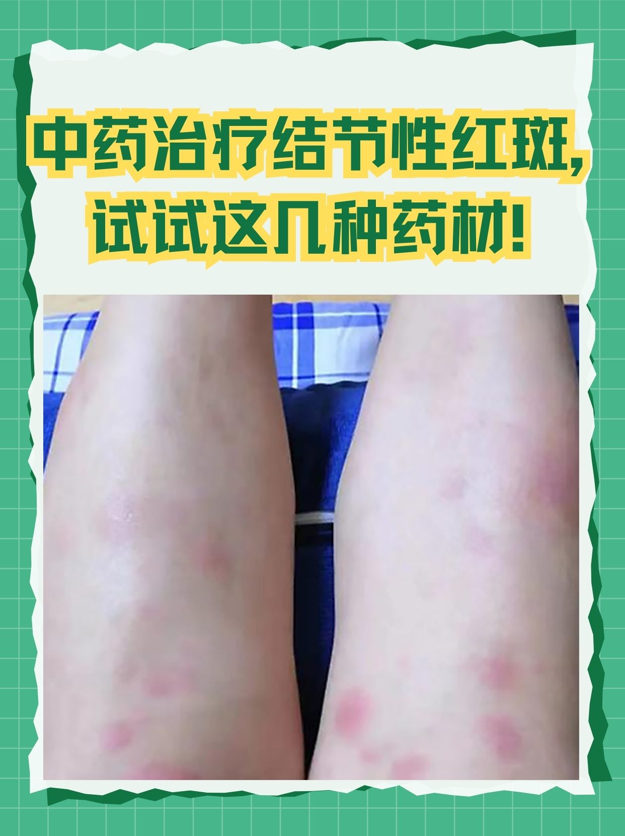 中药治疗结节性红斑,试试这几种药材!