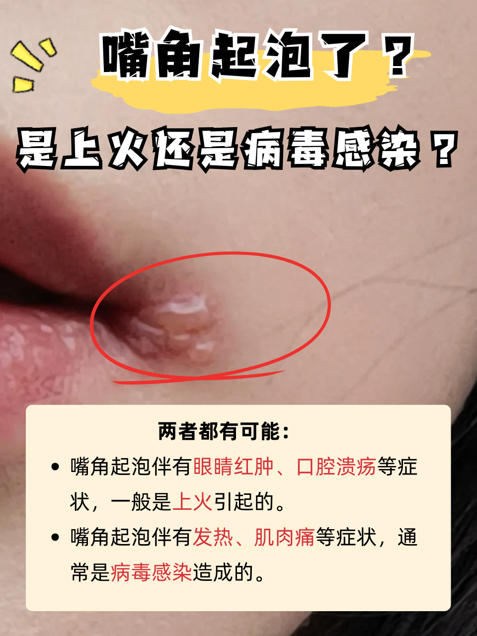 大家可能都出现过嘴角起泡的情况,许多人可能认为这只是上火