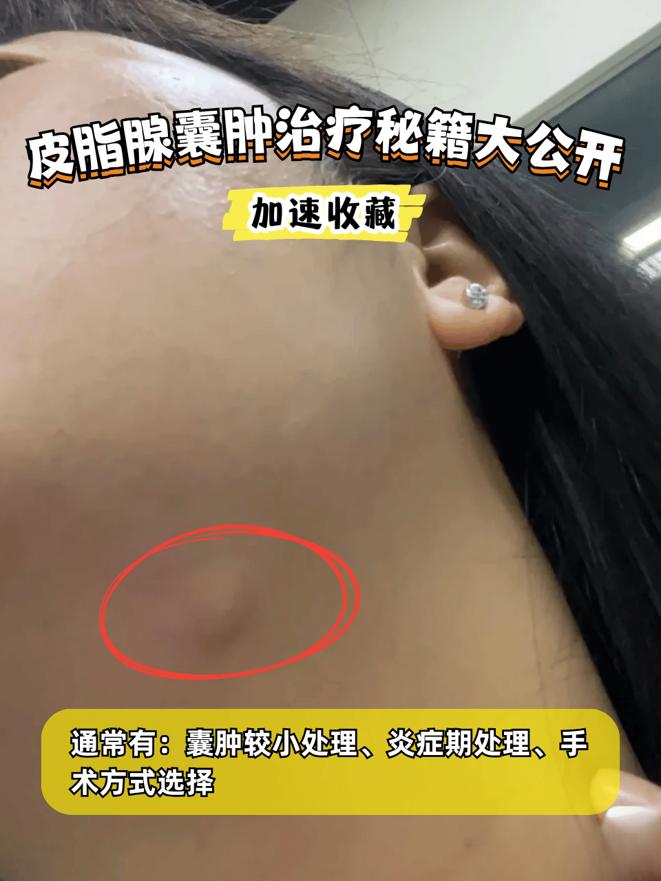 不痛不痒却越挤越大?小心!这可能是皮脂腺囊肿在作怪!