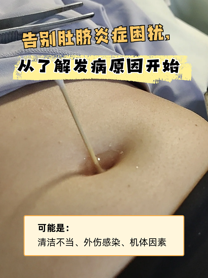 肚脐发炎可不是小事!