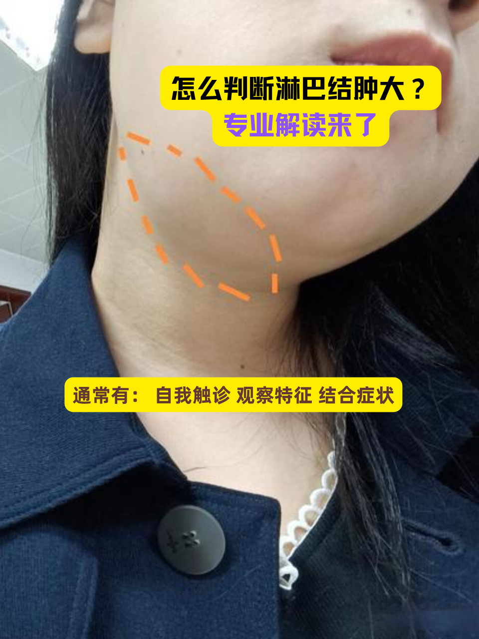 怎么判断淋巴结肿大?