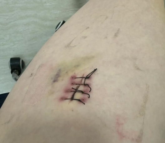 外科缝针黑线长肉里碍事吗