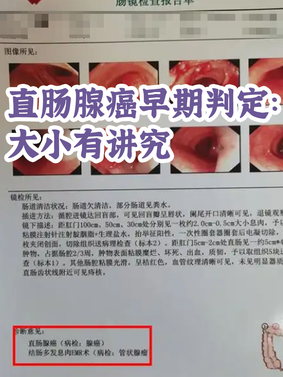 直肠腺癌早期判定:大小有讲究