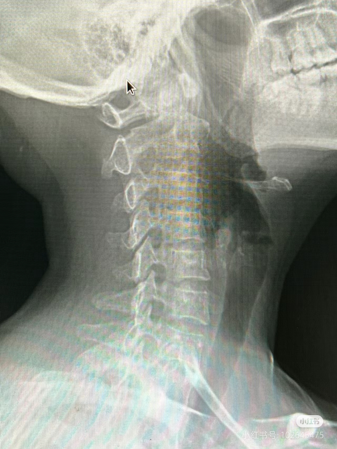 不足视力模糊左侧颈椎疼痛ct拍片头痛拍片头晕图片颈椎变直头昏想吐