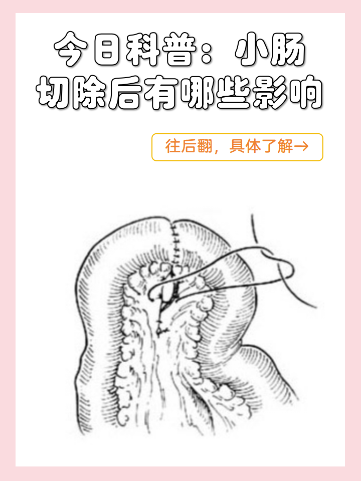 今日科普:小肠切除后有哪些影响?