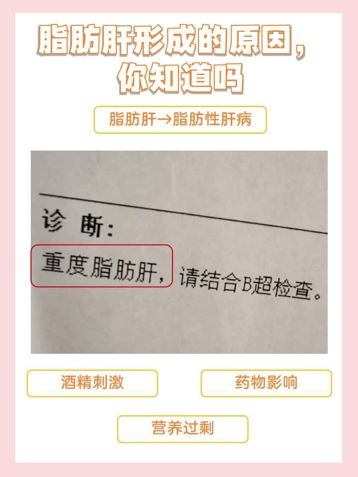 脂肪肝也就是脂肪性肝病,是一种以肝细胞脂肪变为基本病理特征的疾病