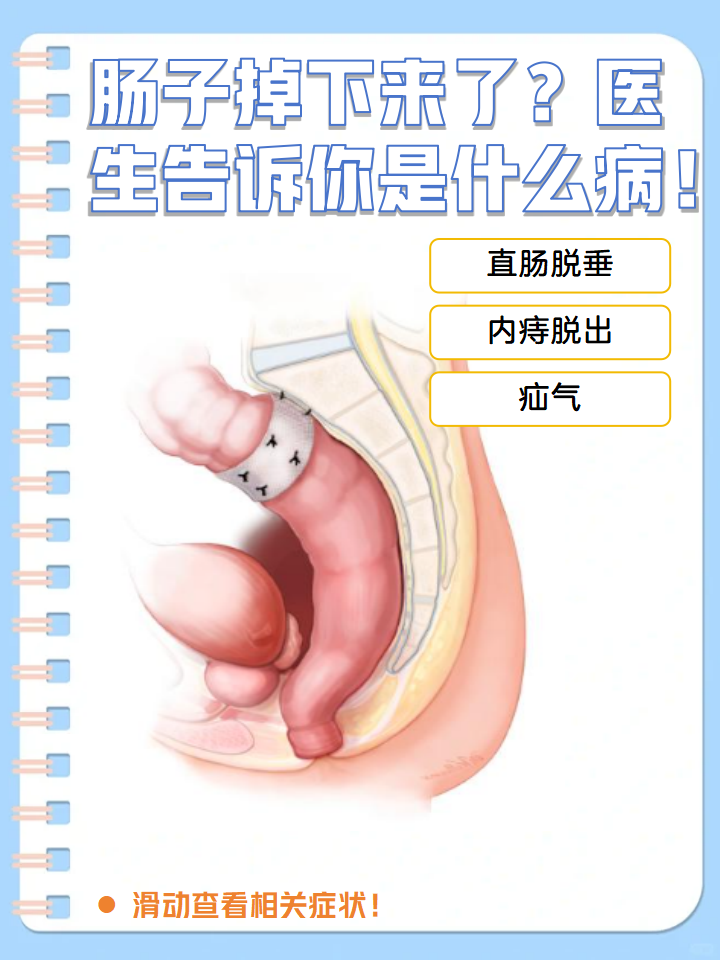 痔疮脱出中期图片