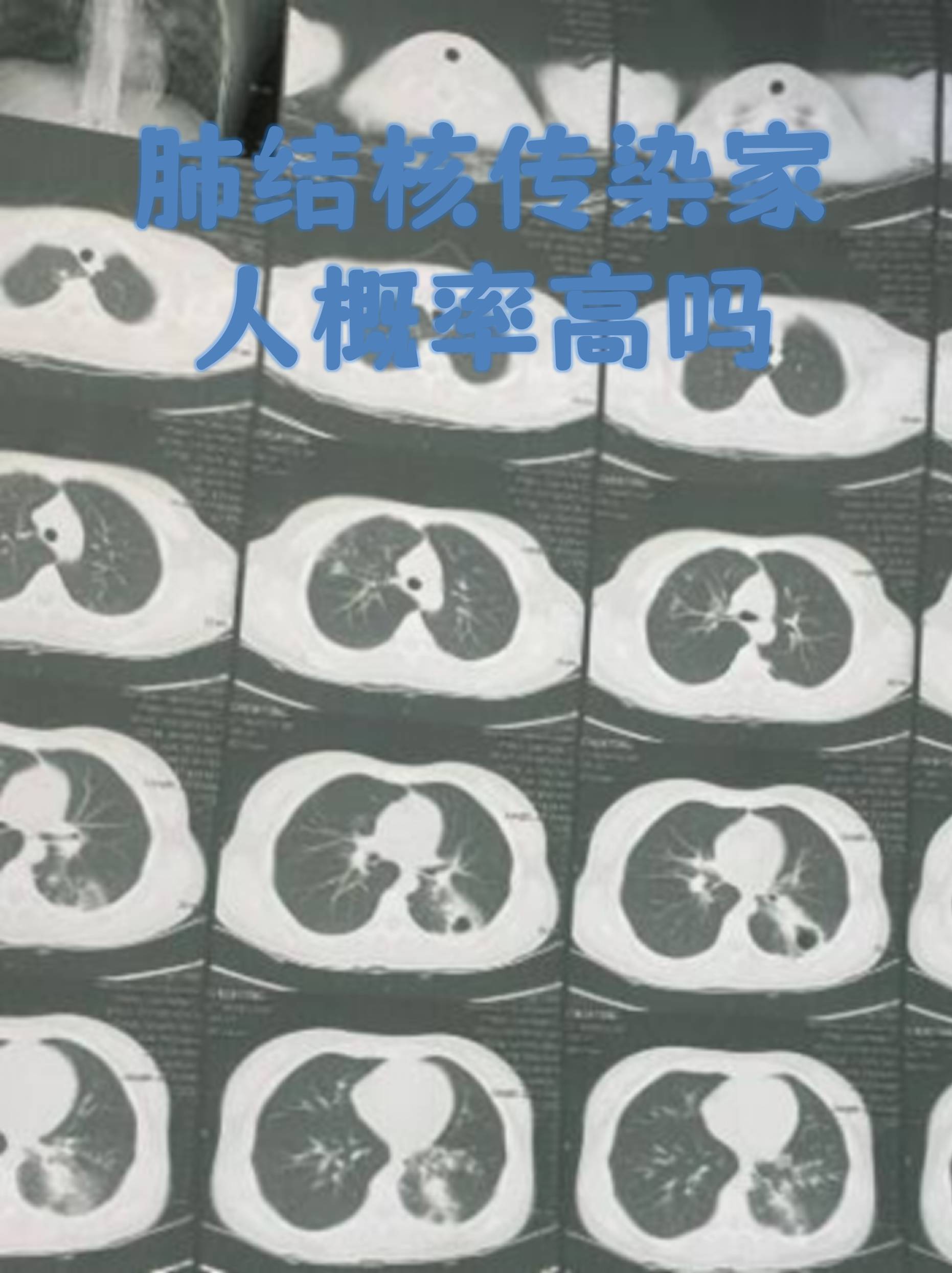 肺结核传染家人概率高吗