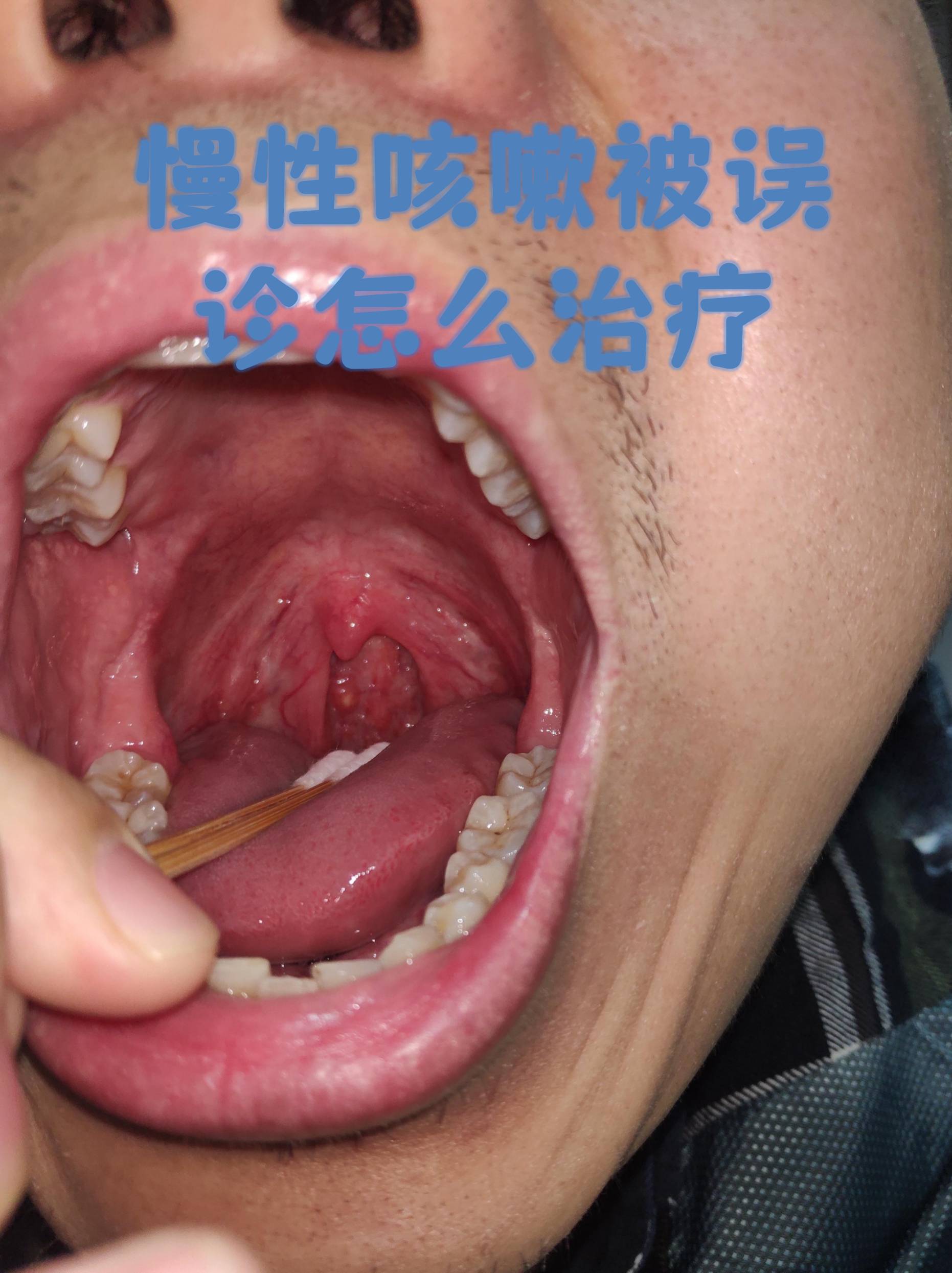  病毒感染嗓子哑(什么病毒会让嗓子变哑)