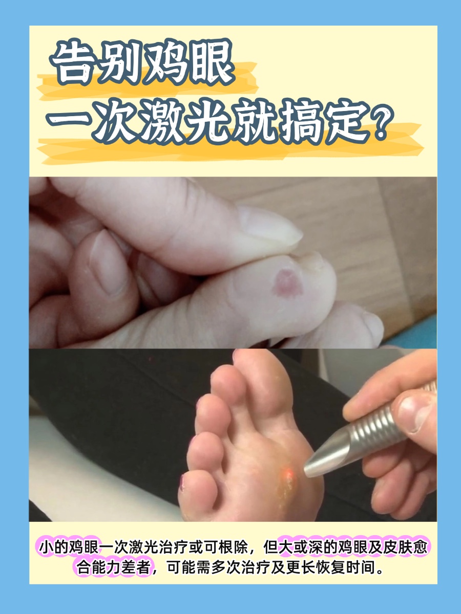 激光治疗鸡眼,是利用激光产生的高温,使鸡眼组织坏死并脱落,从