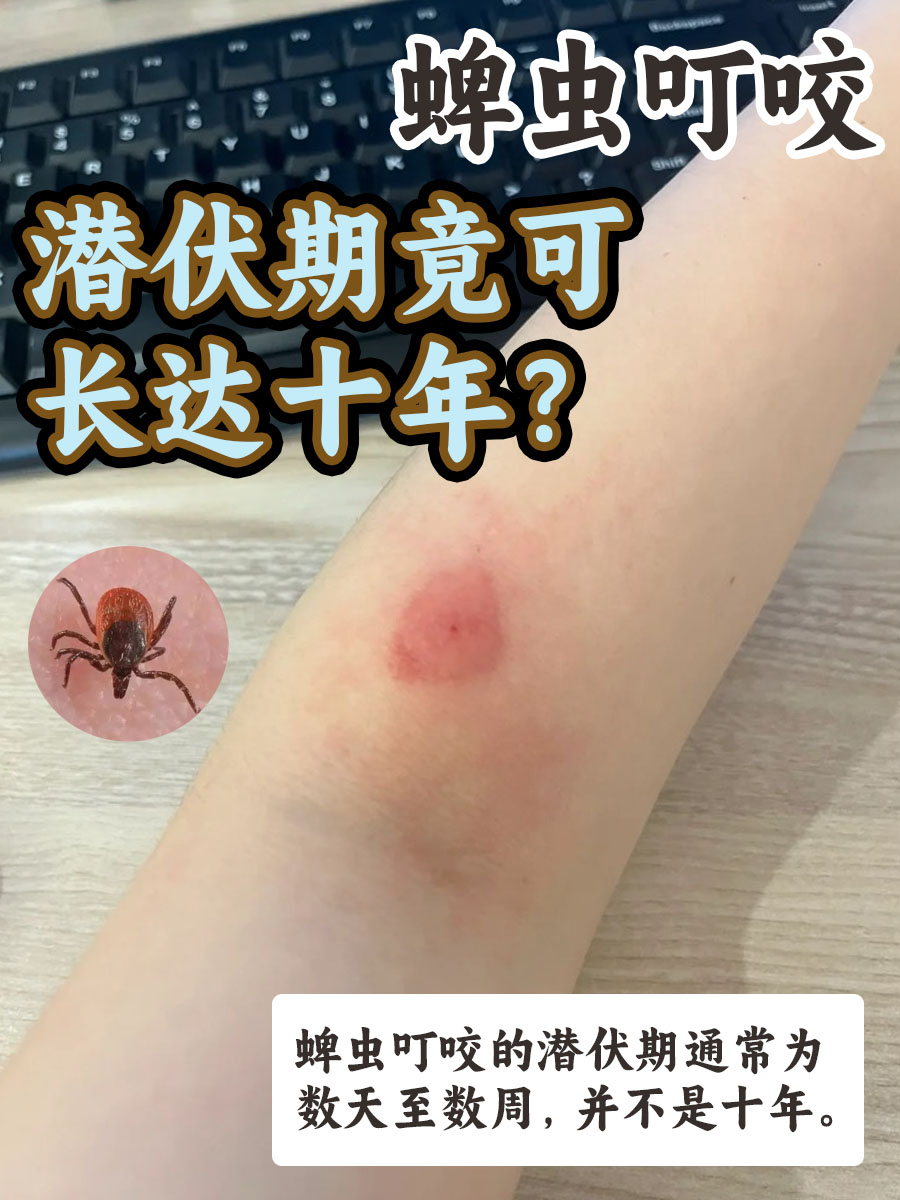 关于蜱虫叮咬后的潜伏期,很多人可能并不了解,甚至存在误解