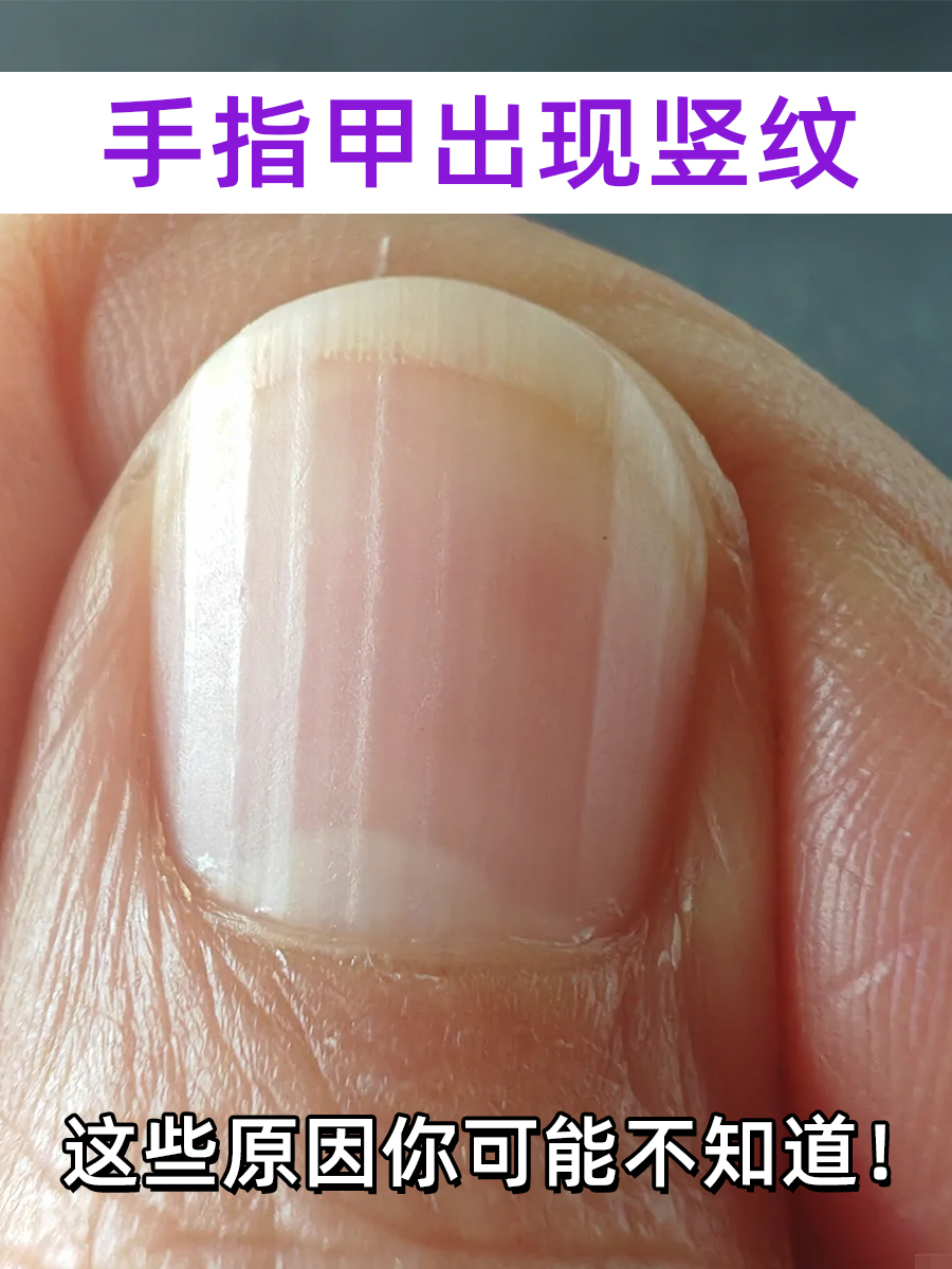 手指甲出现竖纹,这些原因你可能不知道!