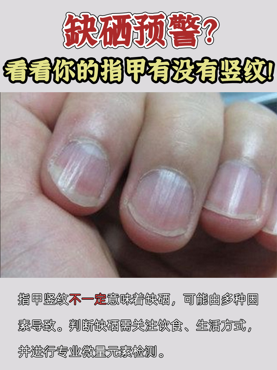 需要明确的是,指甲上的竖纹并不一定意味着缺硒