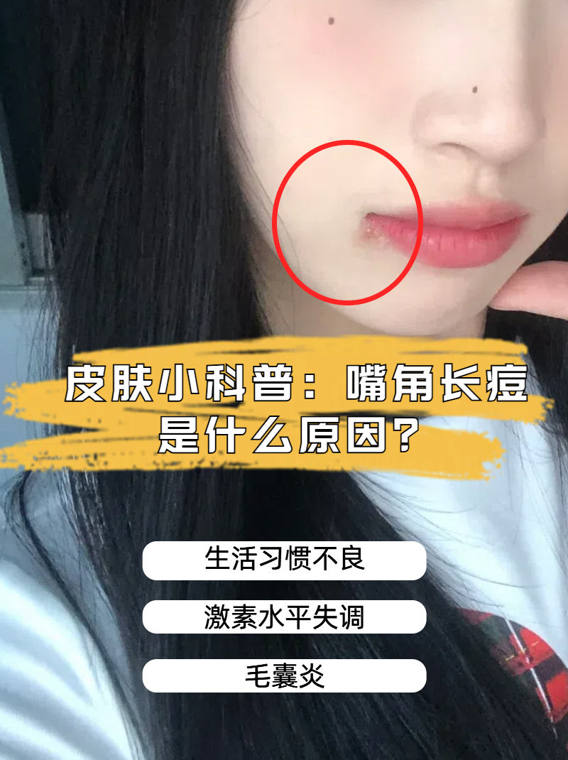 皮肤为什么长痘