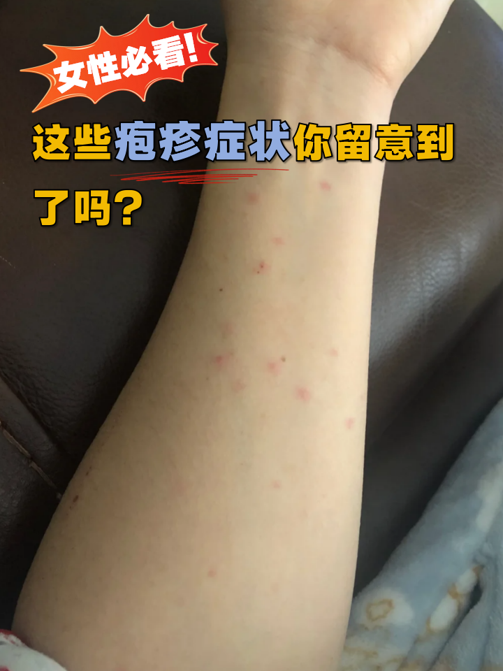 这些疱疹症状你留意到了吗?