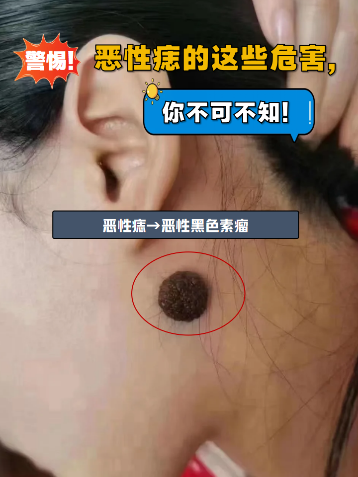 恶性痣的这些危害,你不可不知!