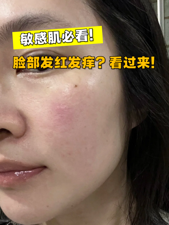 脸部发红发痒?看过来!