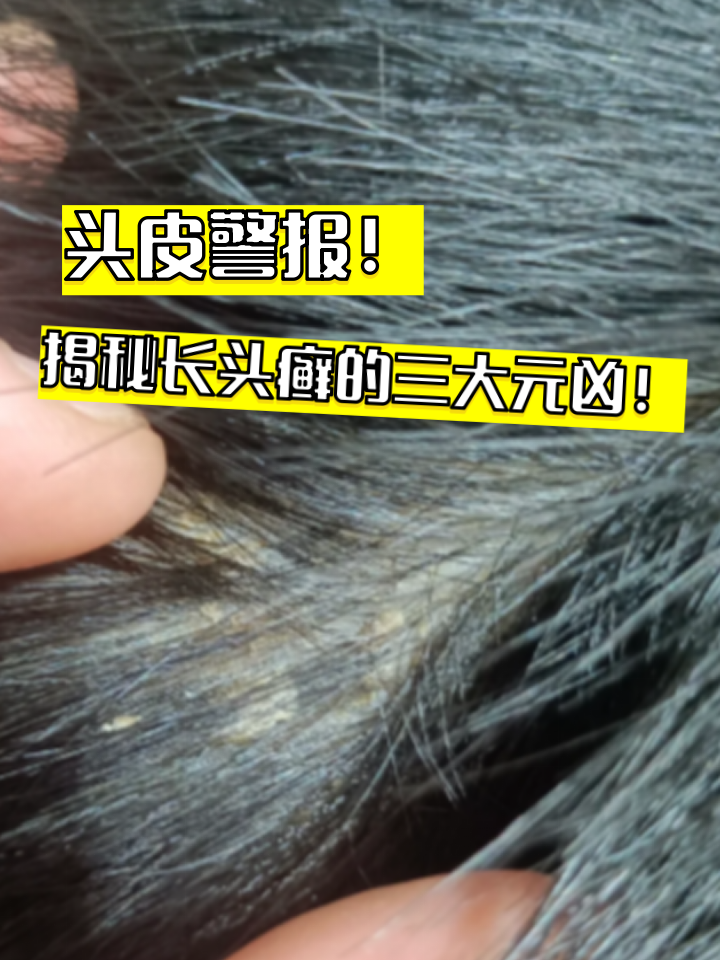 为什么头皮一直很痒