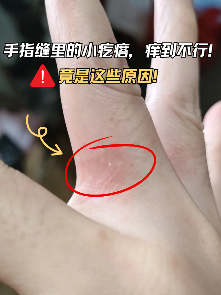 可能是以下几个原因: 疥疮 过敏 湿战甏计笕 手指湿疹手指缝长
