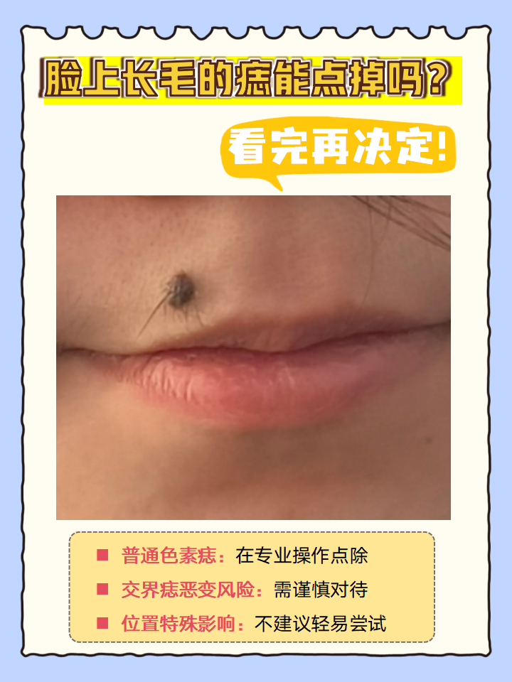 脸上长毛的痣能点掉吗?看完再决定!