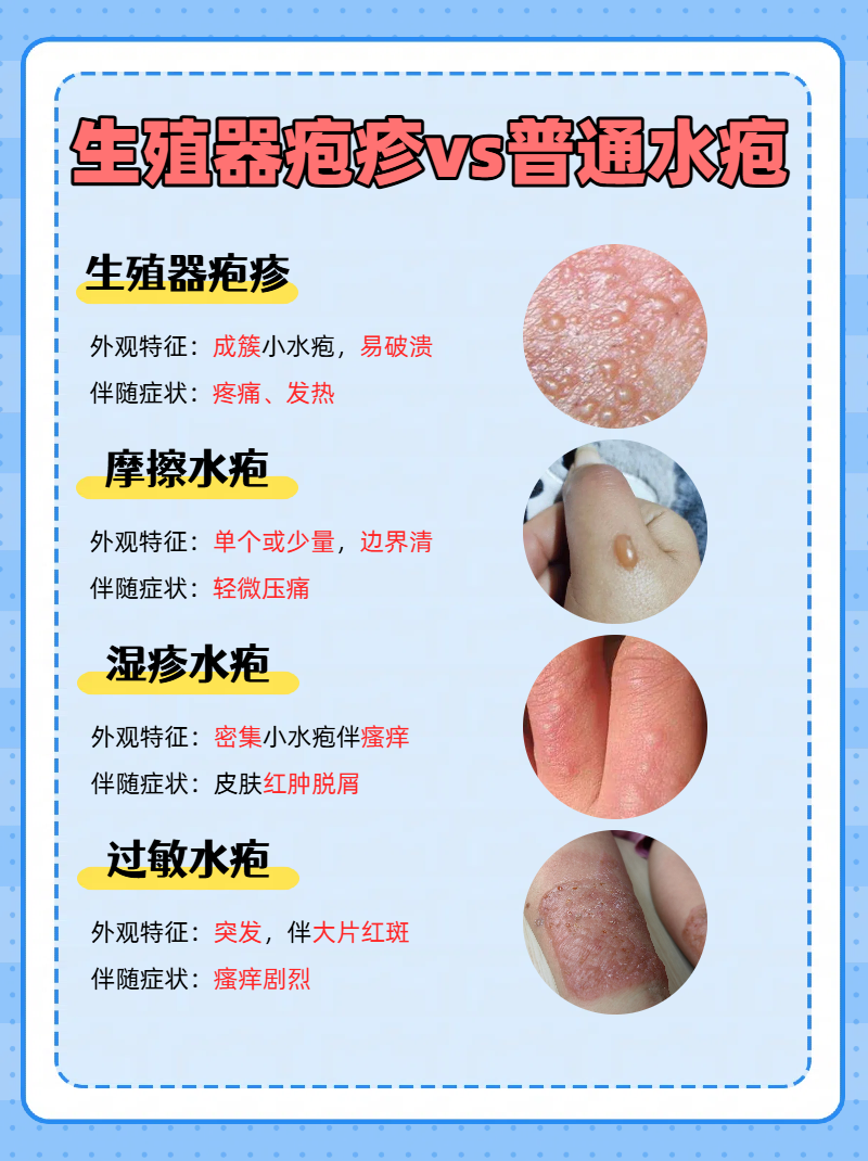 水泡疱疹是因为什么原因引起的