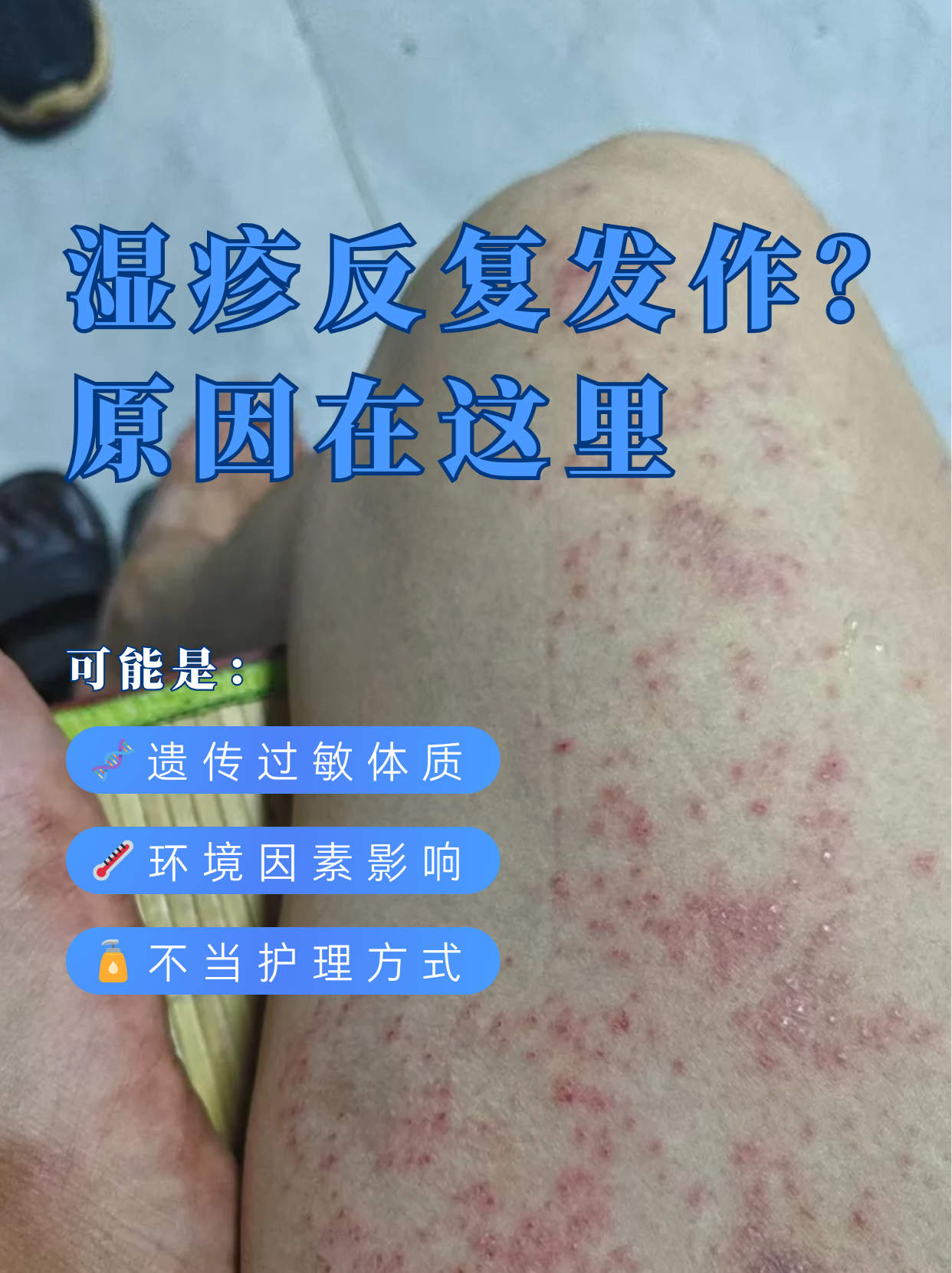 为什么会有湿疹