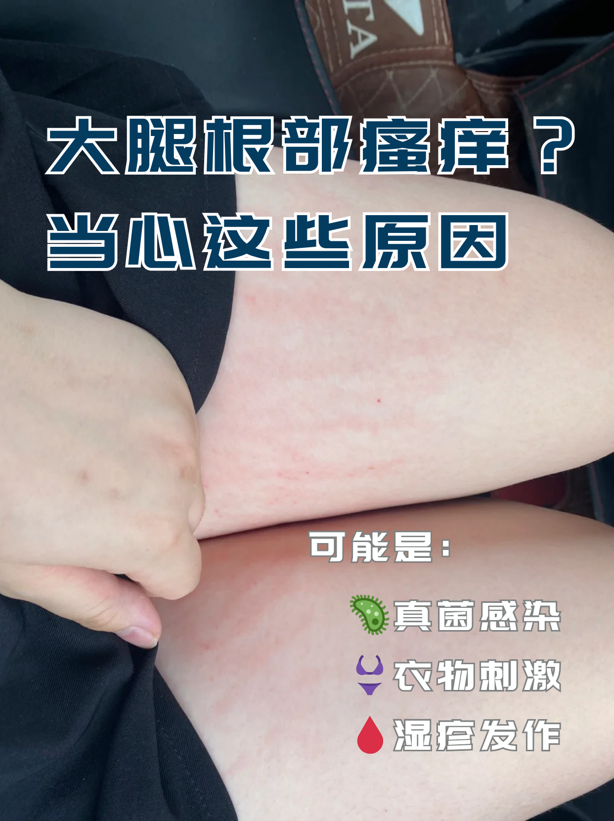 为什么跑步腿会痒