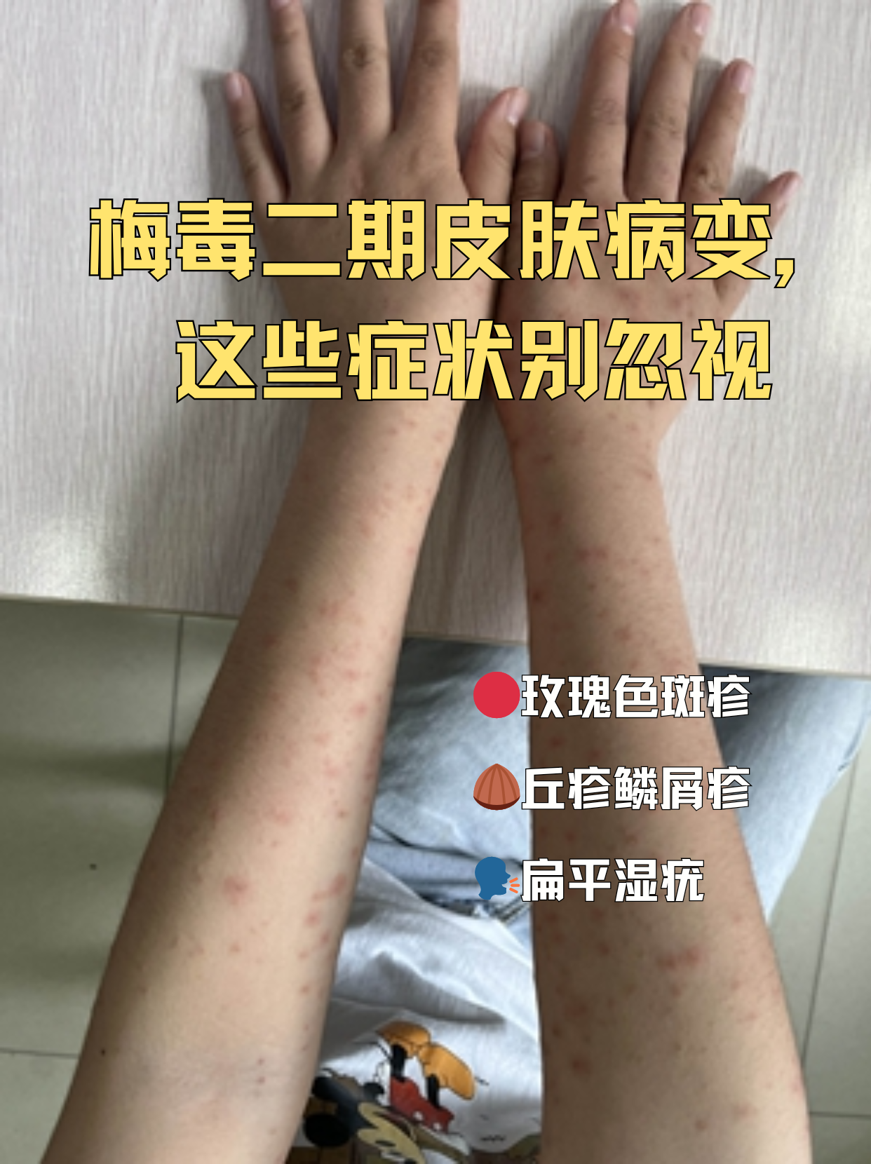 梅毒二期皮肤病变,这些症状别忽视