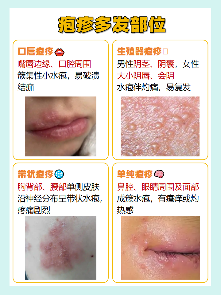 疱疹好转的迹象,这些表现要知道