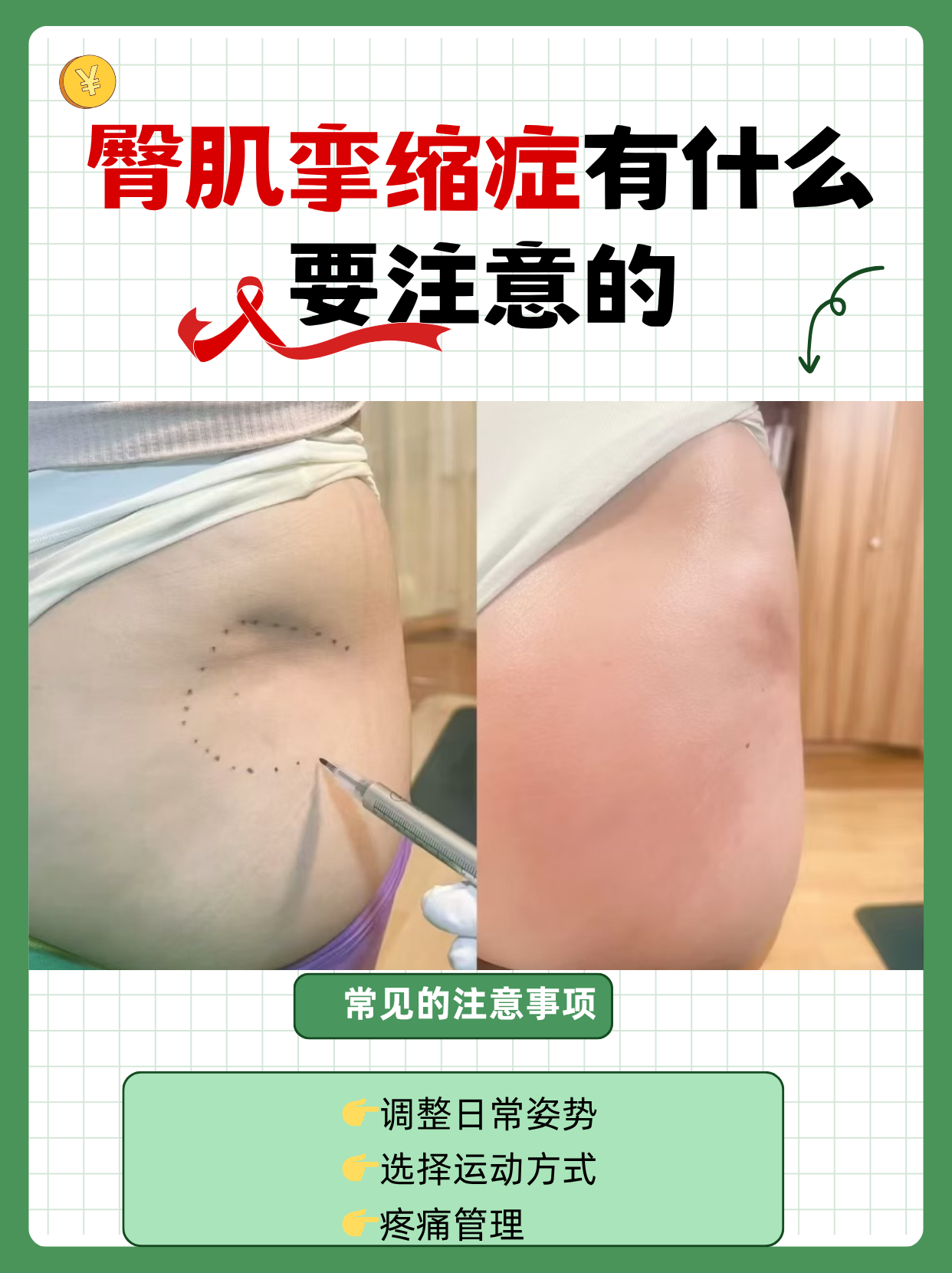 臀肌挛缩症有什么要注意的