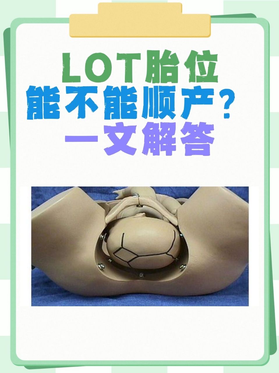 全称为左枕横位,是指胎儿头部位于母体骨盆的左侧,且胎儿的后脑勺(枕