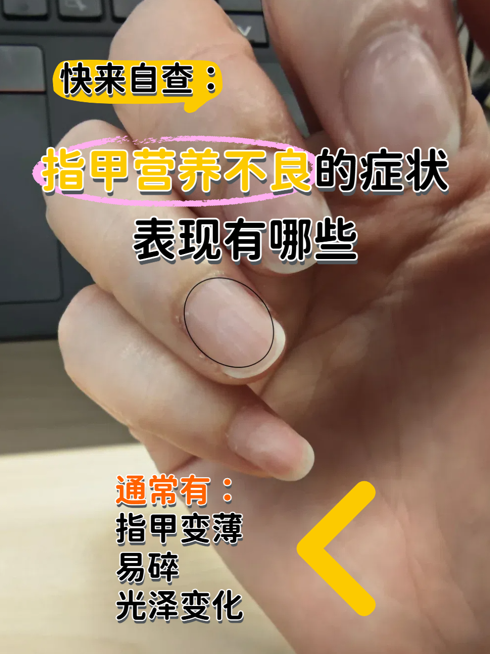 快来自查:指甲营养不良的症状表现有哪些