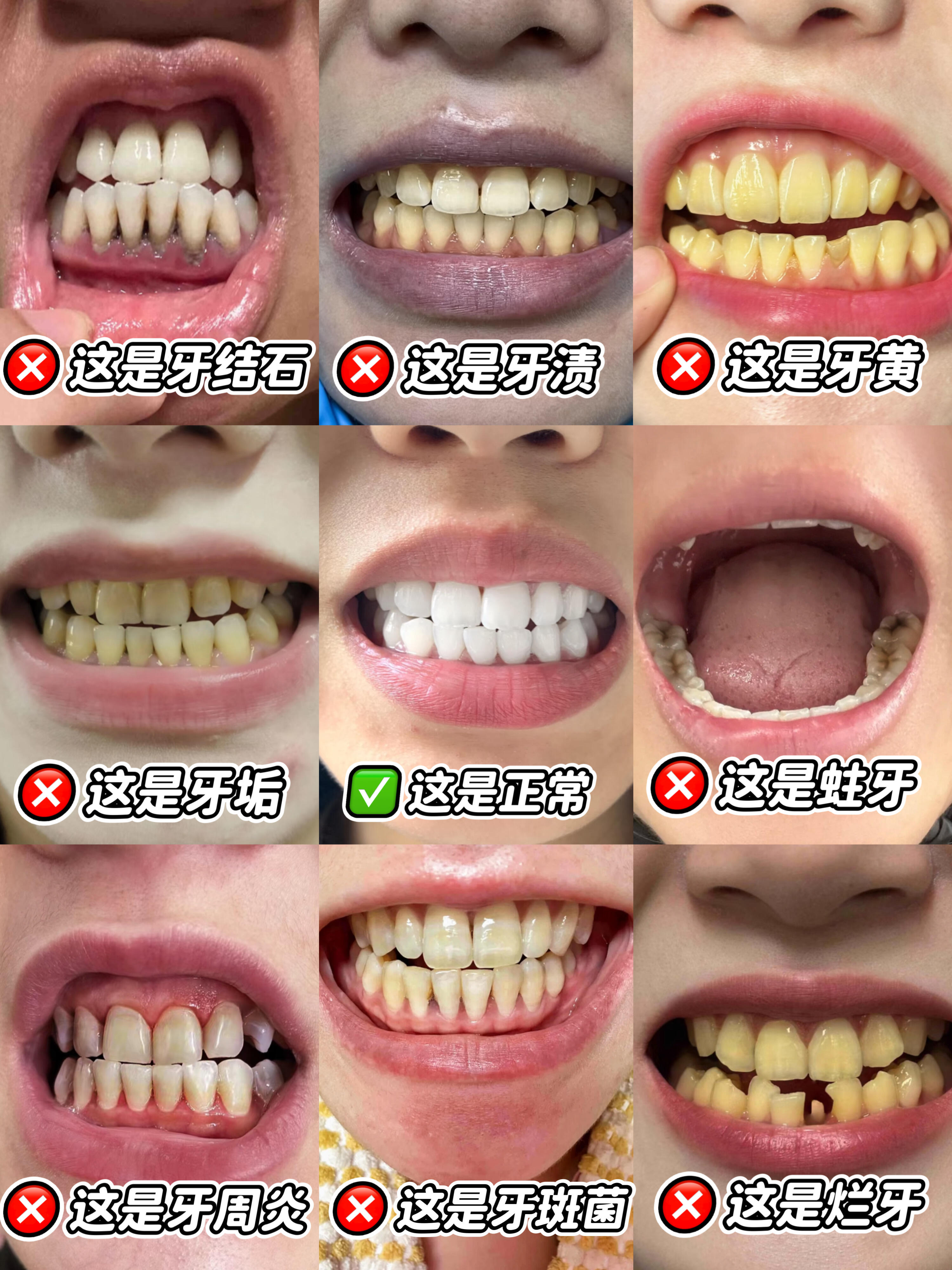 作为一个经历过牙齿问题的人,我想提醒你:千万别对牙齿问题掉以轻心