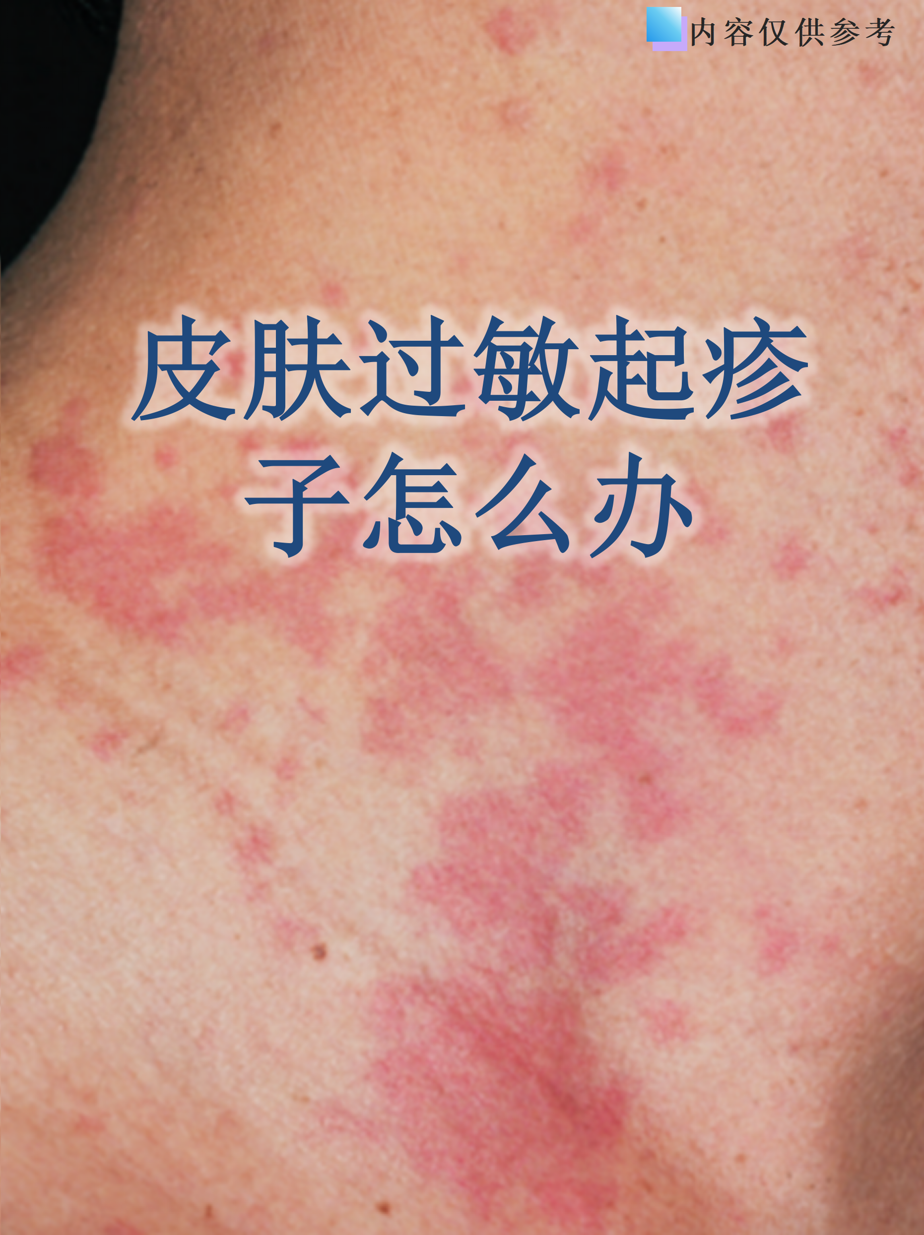 皮肤过敏起疹子怎么办