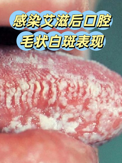 感染艾滋后口腔毛状白斑表现