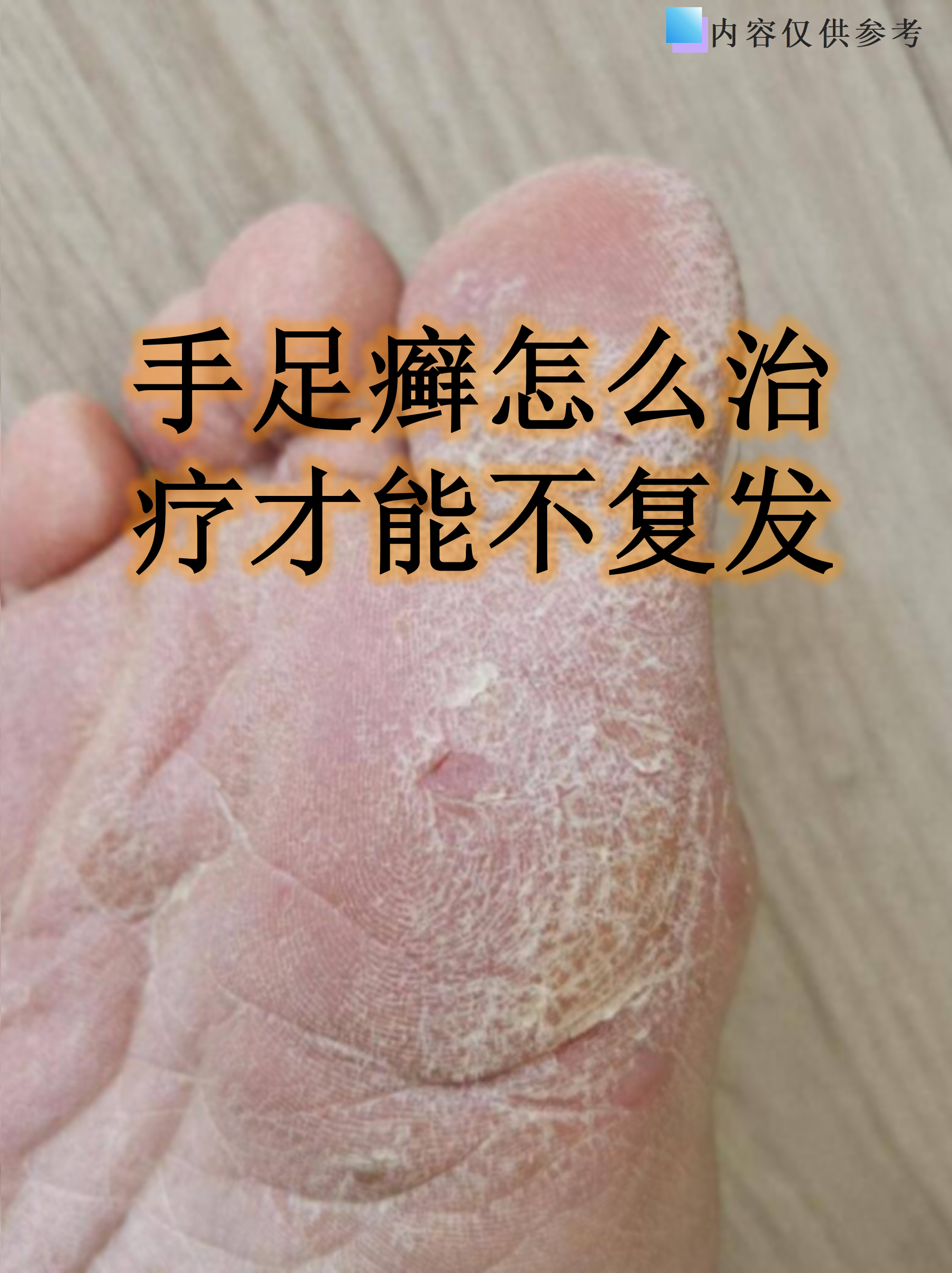 手足癣怎么治疗才能不复发