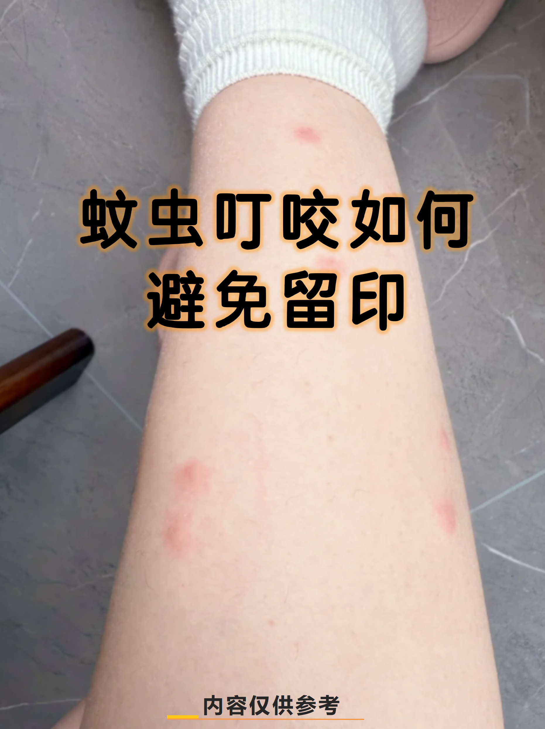 蚊子包为什么会痒