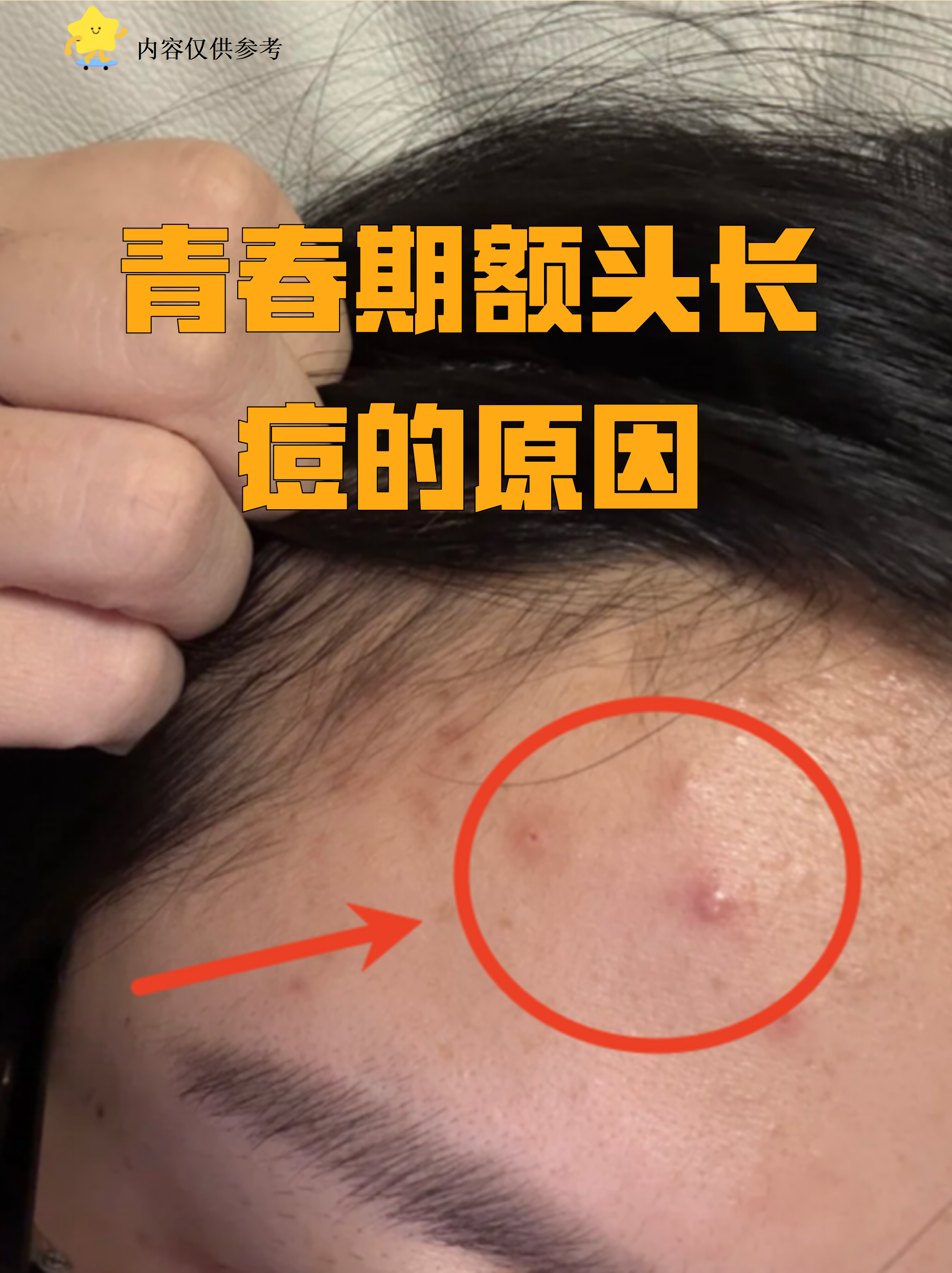 青春期额头长痘的原因