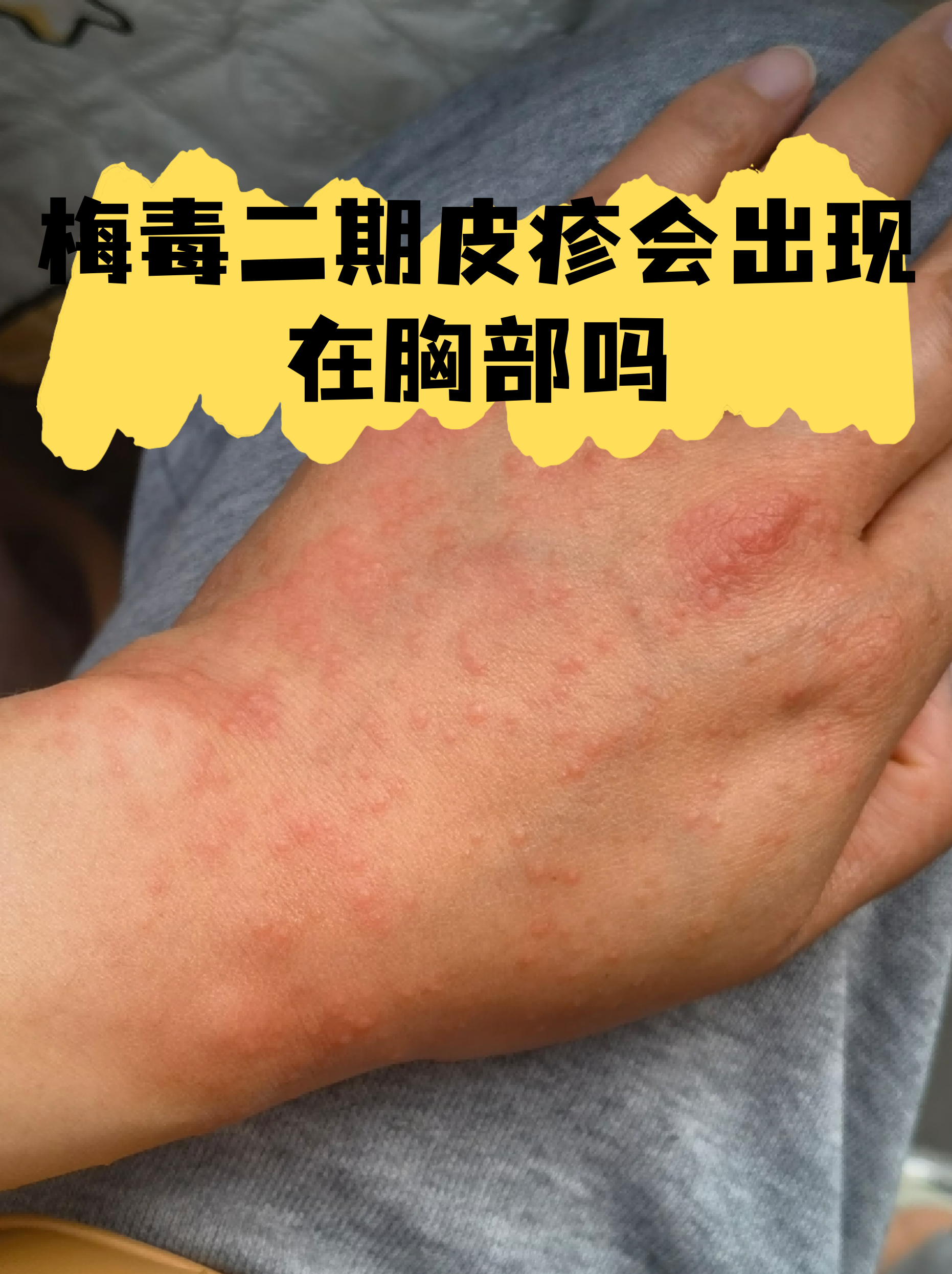 梅毒二期皮疹会出现在胸部吗
