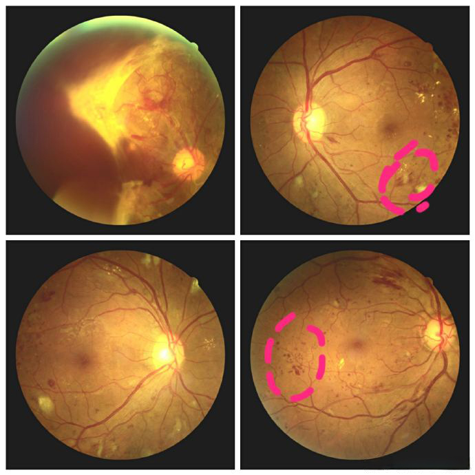 诊间日记#以下三类人群尤其需要定期进行眼底检查,以确保及早发现并