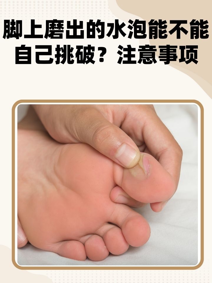 脚上磨出的水泡能不能自己挑破?