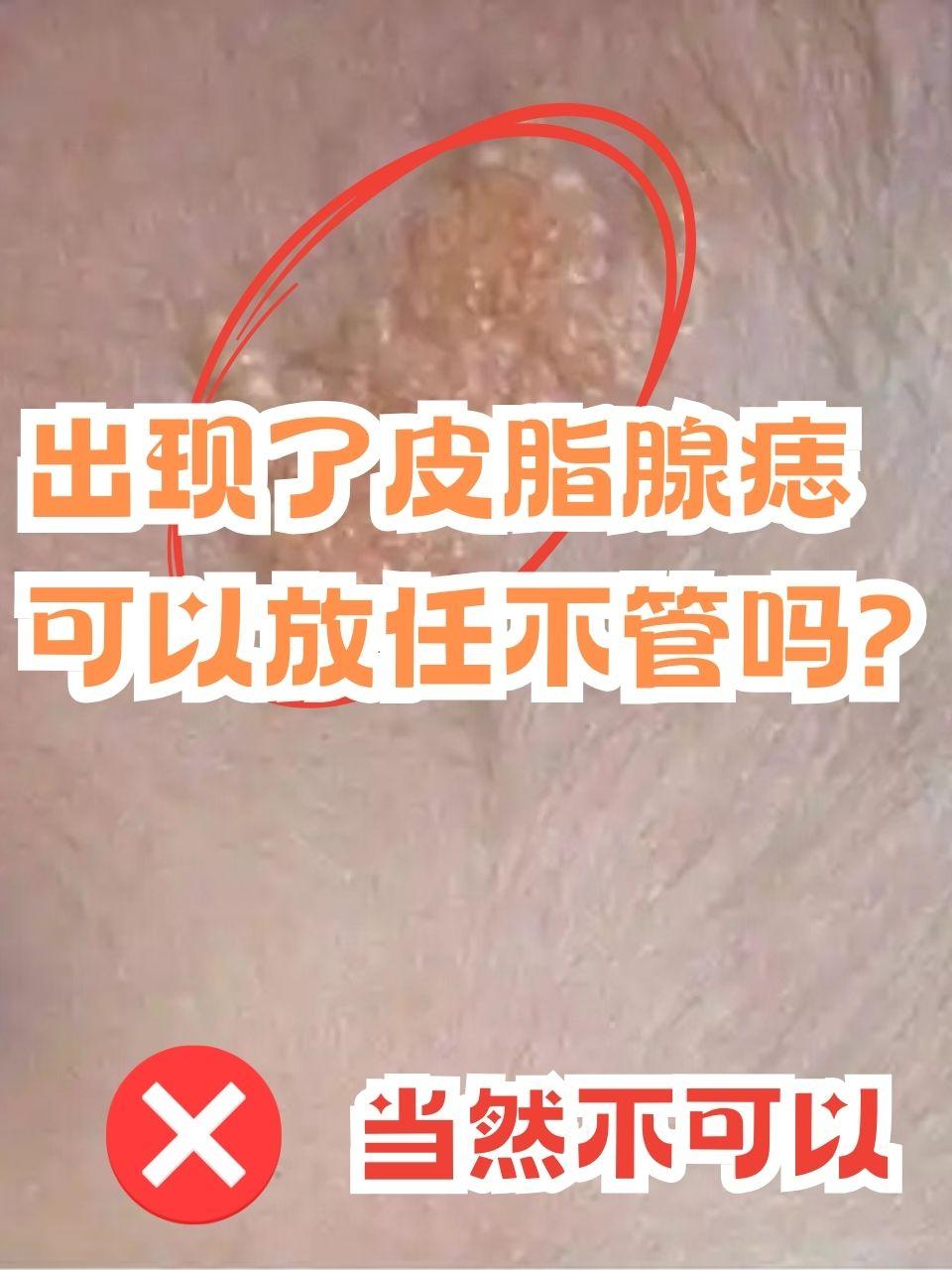 皮脂腺痣是一种相对特殊的存在,它属于皮肤错构瘤,由皮脂腺构成的一种