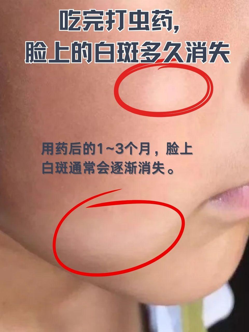 脸上蛔虫白斑的图片白斑长蛔虫脸上白斑图片蛔虫斑脸部图片虫斑和白斑